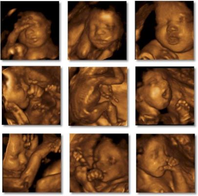 Collage of Sonogram Images